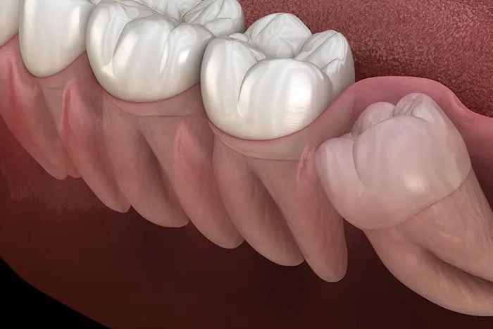 20 Yaş Gömülü Diş Çekimleri