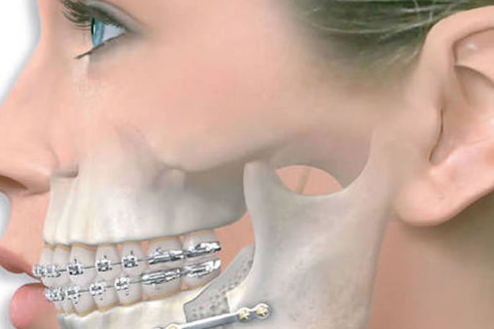 Çene Eklemi Tedavisi (TME Tedavisi)