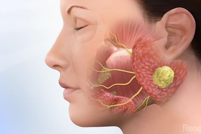 Çene Tümörleri ve Kist Cerrahisi