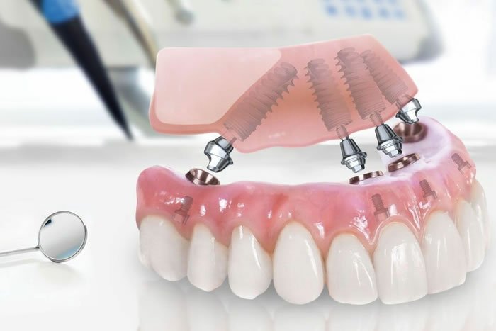 Dijital İmplant Planlaması (Navigasyonlu İmplant)