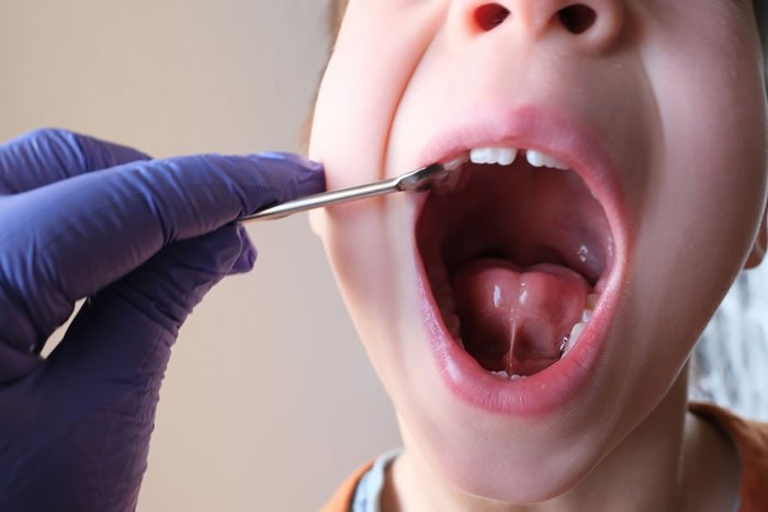 Çocuklarda Frenektomi