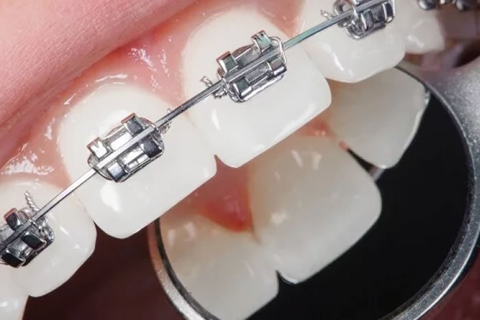 İleri İşlevsel Ortodontik Tedavi