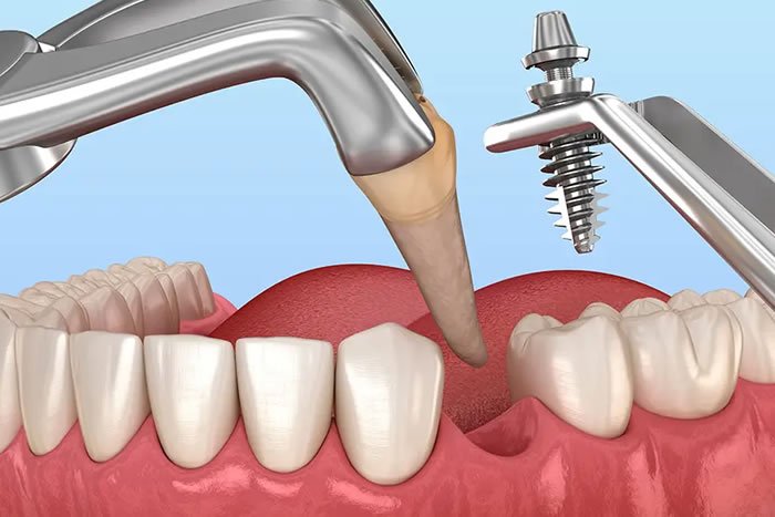 İmmediate İmplant (Çekimle Aynı Anda İmplant)