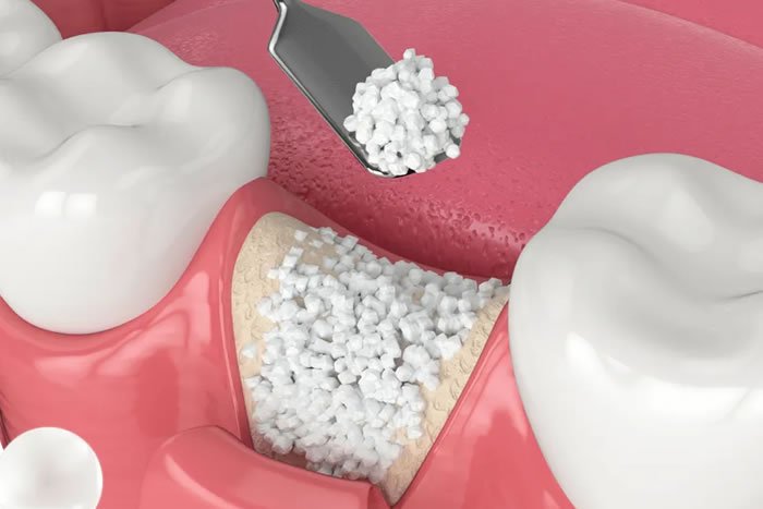 Kemik Grefti (Kemik Tozu Uygulaması)