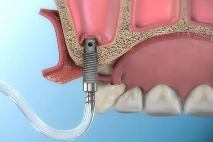 Sinüs Lifting (Sinüs Kaldırma Operasyonu)