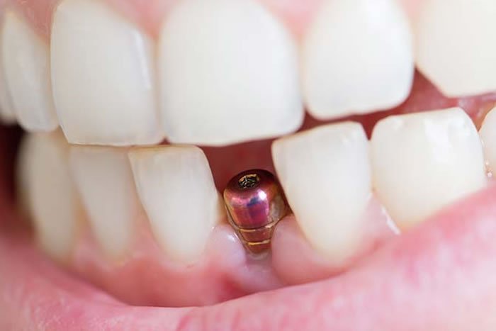 Tek Diş İmplant Tedavisi